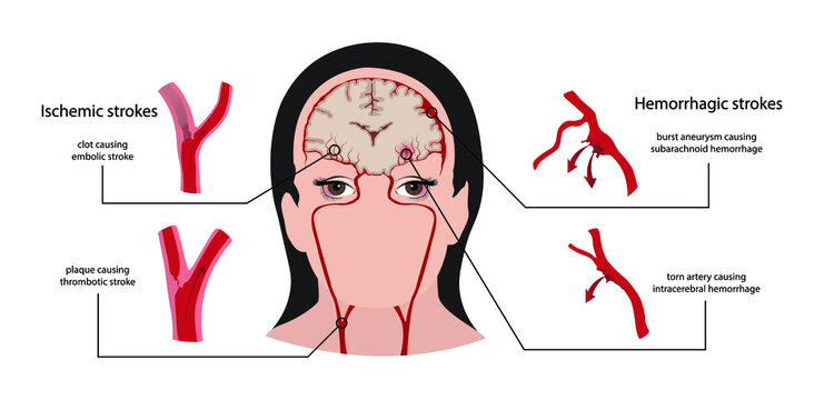 illustration of biology and medical, burst blood vessel in the brain symptoms, ischaemic stroke and haemorrhagic stroke, A stroke is a serious medical emergency and a major cause of death