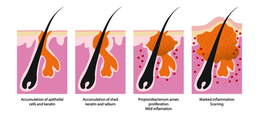 illustration of biology and medical, Clogged pores are a common skin concern that may lead to acne, Skin problems, acne, pimples and clogged pores, swelling, pain and irritation deep in the skin
