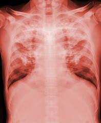  Chest xray image showign TB,tuberculosis or covid-19 .