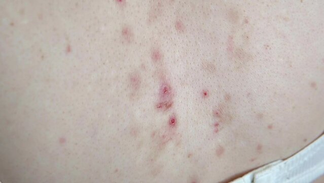 Acne sequelae, torn pimples, skin itching on the back, dermatological problem. 