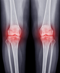 Film x-ray  both knee joint  AP view