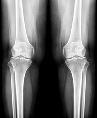 Film x-ray  both knee joint  AP view