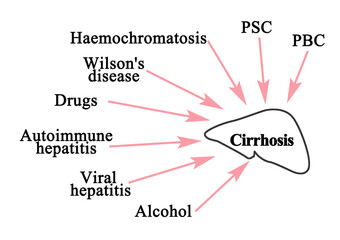 Eight major causes of Cirrhosis