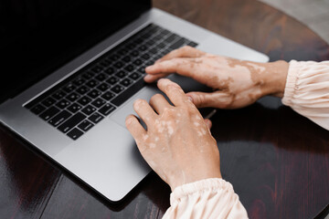 Girl with vitiligo skin pigmentation on the hands typing on laptop online close-up. Skin seasonal...