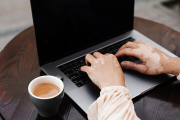 Typing text on laptop. Hands with vitiligo pigmentation seasonal skin disease. Working online....
