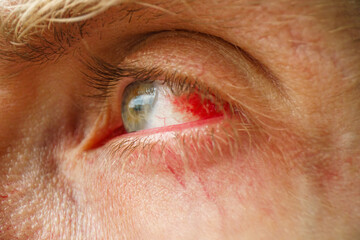 Subconjunctival hemorrhage - hyposphagma. Closeup of red bloodshot eye. Eye with burst blood...