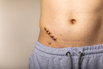 Naklejka premium A man shows an appendicitis scar on his stomach, a scar from an appendicitis operation on his stomach. appendectomy.Medicine concept.Copy space.