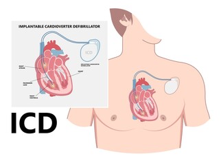 Pacemaker ICD Implantable Cardioverte Defibrillator Pulse Generator Stimulate of Heart Prevent Bradycardia Electronic Medical Device - obrazy, fototapety, plakaty