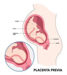 vasa previa in fetus fetal infant baby born birth defect c section nuchal cord twins vessels funic labor growth low lying fluid of PROM test increta cervix Bilobed sac uterus neck knotted Contraction