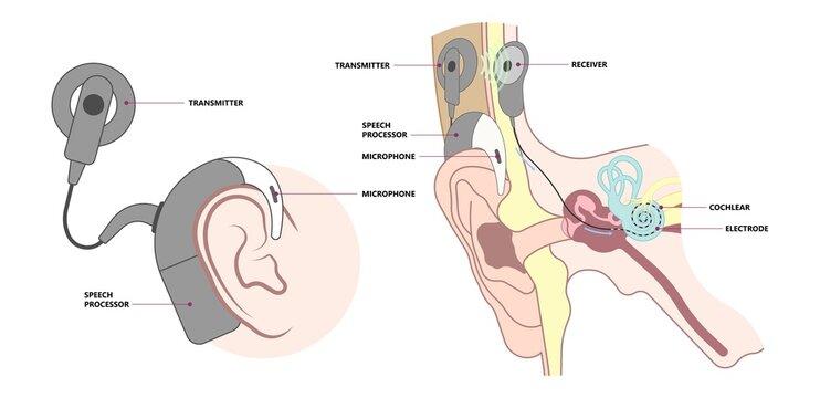 hearing aid ear child deaf signal baby inner middle bone loss outer canal birth meniere's cochlea brain implantation test exam