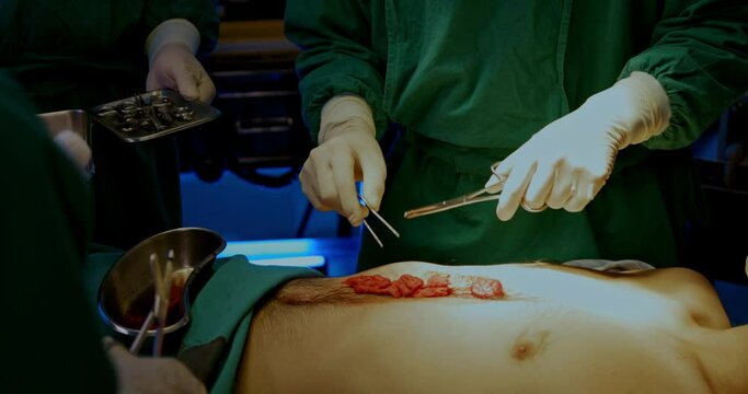 Surgeon and Group doctor assistant are performing abdominal surgery on patients in emergency operating room. Expert medical team uses modern treatment technology. concept of medical service	