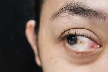 A Woman with Brown Spot on her Sclera Diagnosed as Hemorrhagic Conjunctivitis