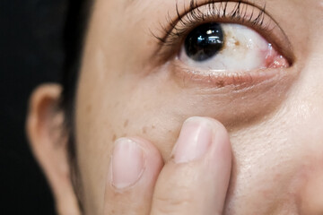 A Woman with Brown Spot on her Sclera Diagnosed as Hemorrhagic Conjunctivitis