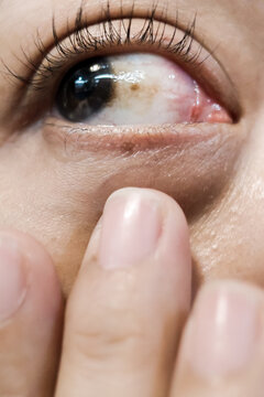 A Woman with Brown Spot on her Sclera Diagnosed as Hemorrhagic Conjunctivitis