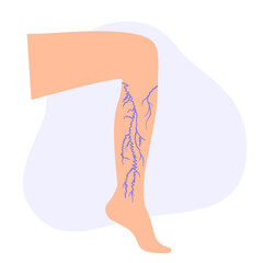 Varicose veins treatment