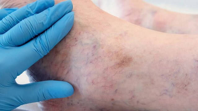 Phlebeurysm. Examination of the veins on the leg by the doctor close-up. 4K footage