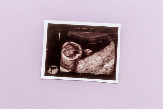 Ultrasound picture of unborn baby - pregnancy concept