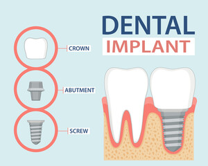 Dental implant infographic. Information poster tooth replacement