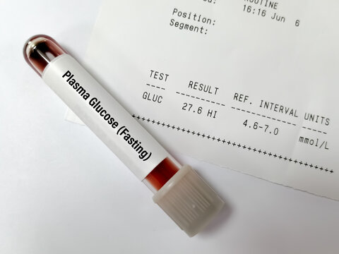 Sample tube of Plasma glucose Fasting test with abnormal report called hyperglycemia.
