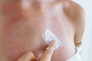 Woman's hand smears anti-burn cream on skin after sunburn