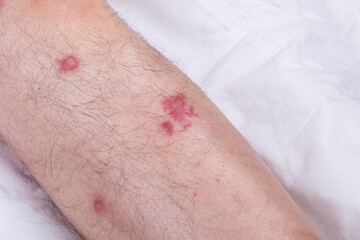 Fototapeta premium male legs with hair are lying on a white sheet. there are many small redness