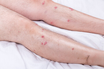 male legs with hair are lying on a white sheet. there are many small redness