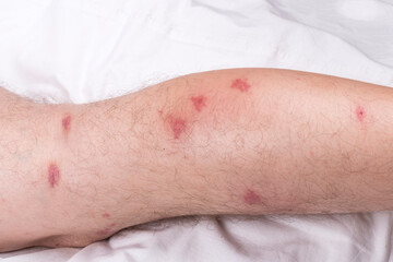 male legs with hair are lying on a white sheet. there are many small redness