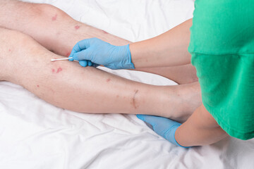 male legs with hair are lying on a white sheet. there are many small redness