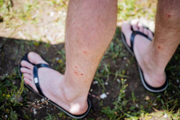 Artificial human legs from insect bites, red dots of midge bite, legs dressed in slate, summer vacation in nature, pain in the limbs.