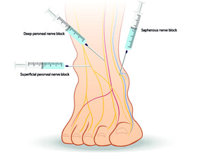 Lower extremity nerve block -Ankle front view. Regional anesthesia ilustration. Needle placement.  - obrazy, fototapety, plakaty