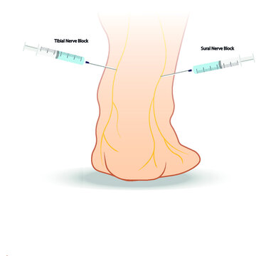 Lower Extremity Nerve Block -Ankle Bkack View. Regional Anesthesia Ilustration. Needle Placement. 