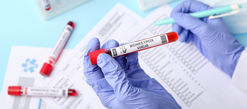 Doctor with sample of monkeypox virus in clinic, closeup - Powered by Adobe