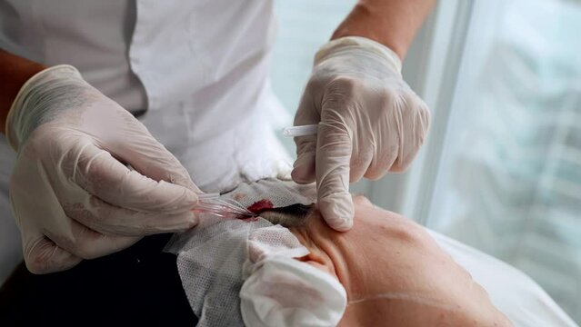 threadlifting with mesothreads at aesthetic clinic, installing thread-kogi under facial skin