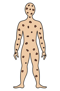 Smallpox on the human body. Color vector illustration. The face and body of the patient is covered with spots. Muscular man in full growth. Isolated background. Cartoon style. Medical theme. 