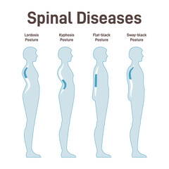 Diseases of the spine. Lordosis, kyphosis, flat-back and sway-back