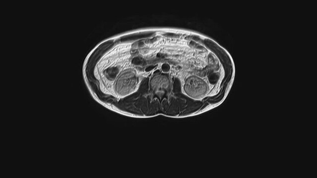 Voluminous CT scan of the abdomen. Computed tomography of the gastrointestinal tract, liver and kidneys
