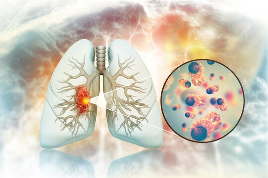 Lung cancer, symptoms, stages, treatment, 3d illustration