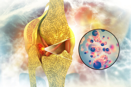 Bone cancer, knee joint, giant cell tumor of bone, osteosarcoma, 3d illustration