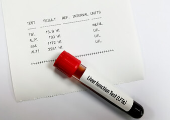 Blood sample isolated for Liver function test (LFTs) including ALT, AST, ALP and Total bilirubin with abnormal patient report.