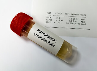 Urine Sample for Urine ACR or microalbumin creatinine Ratio. Chronic kidney disease (CKD).
