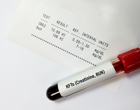 Blood sample tube isolated for Creatinine and BUN with abnormal report for the diagnosis of Kidney Function test.