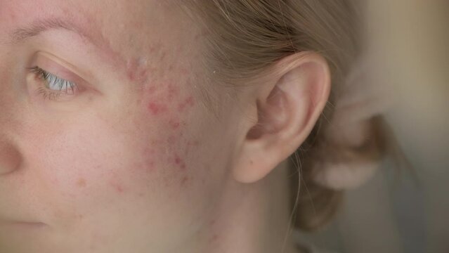 Smiling woman with post acne scars. Skin health. 