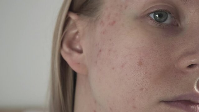 Woman with post acne scars. Skin health. 