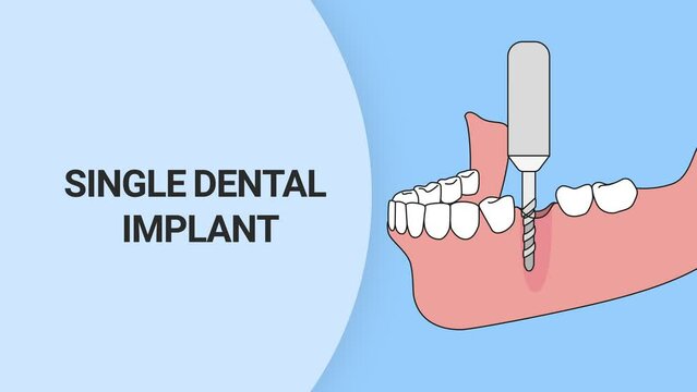 Process to place single dental implant