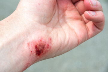 Red wound on the palm, arm, wrist after a burn or fall. First aid in wound treatment. Treatment of wounds. Extreme close up of a red skin burn