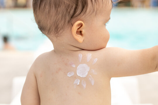 baby sitting on white beach chair with sun shape from white cream,body lotion,painted on shoulder.sun protective,pf  emulsion.toddler with allergy, red dots on back.summer vacation,sea, trip.family