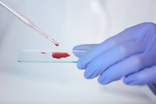 Close-up of unrecognizable lab worker in rubber gloves dropping blood sample on microscope slide while making blood test to diagnose treatment