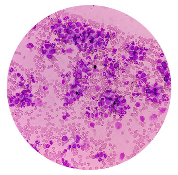 Microscopic image showing Chronic myeloid leukaemia (CML) is a type of cancer, all stage of granulocytic maturation is noted, CML in chronic phase.
