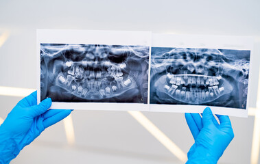 Professional teeth xray screening. Diagnosing dental modern technologies.