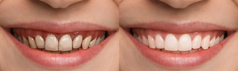 Collage with photos of young woman before and after dental treatment, closeup. Banner design